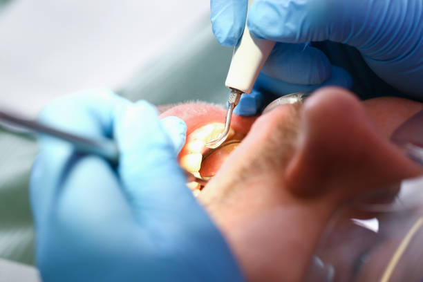 Best Knocked-Out Tooth (Avulsed Tooth) Treatment in Lithopolis, OH